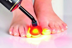 Fotodynamiczna terapia PACT® MED przeciw grzybicy paznokci