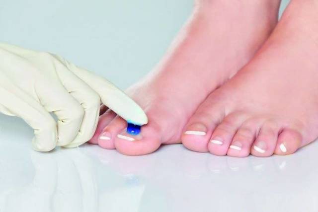 Fotodynamiczna terapia PACT® MED przeciw grzybicy paznokci